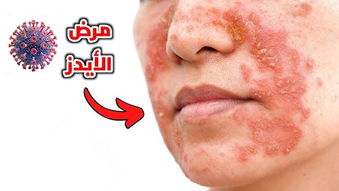 ماهو مرض الأيدز وكيف ينتقل وماهي أعراضة؟!(ثقف نفسك)_ !? What is AIDS