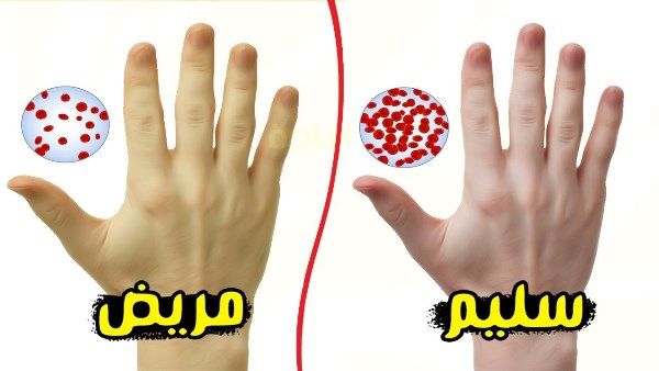 اعراض نقص الحديد