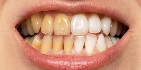 مشروبات شهيرة تسبّب اصفرار الأسنان.. طرق طبيعية لاستعادة بياضها - الفجر سبورت