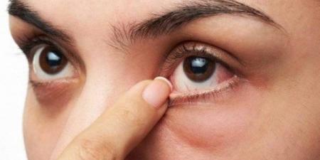 9 نصائح طبيعية للتخلص من حرقة العين و جفافها - الفجر سبورت