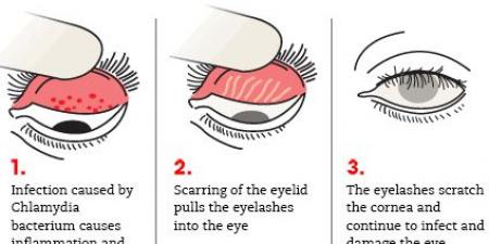 مصر تسجل إنجازًا صحيًا تاريخيًا.. القضاء على التراكوما وإعلان خلو البلاد من المرض .. بوابة الفجر سبورت