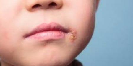 الهربس عند الأطفال.. كيف تميّز أعراض المرض وسط تشابهها مع نزلات البرد؟ - الفجر سبورت