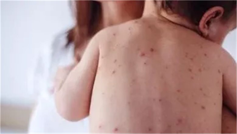 الهلال الأحمر يحذر من خطورة الحصبة ومضاعفاتها على الأطفال